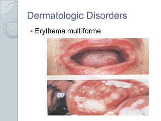 Dermatologic Disorders<br />Erythema multiforme<br />