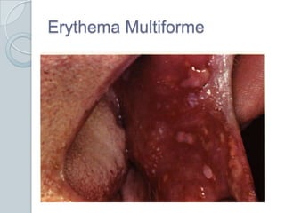 Erythema Multiforme<br />