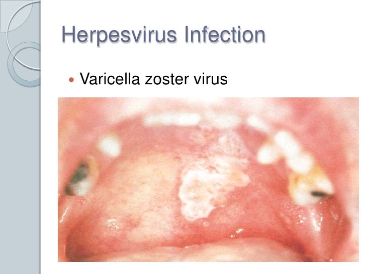 Oral cavity lesions