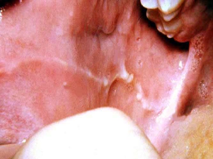 White Oral Lesion 76