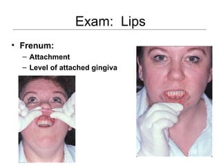 Exam: Lips
• Frenum:
– Attachment
– Level of attached gingiva
 