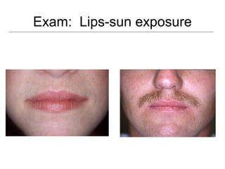 Exam: Lips-sun exposure
 