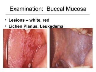 Examination: Buccal Mucosa
• Lesions – white, red
• Lichen Planus, Leukedema
 