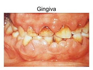 Gingiva
 