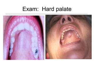 Exam: Hard palate
 