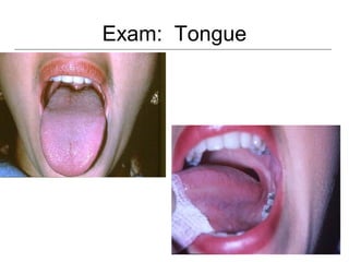 Exam: Tongue
 