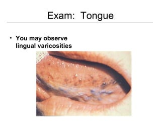Exam: Tongue
• You may observe
lingual varicosities
 