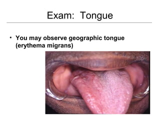 Exam: Tongue
• You may observe geographic tongue
(erythema migrans)
 