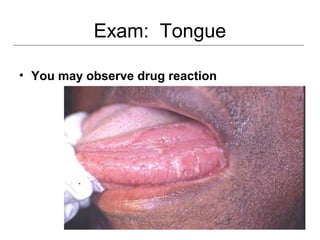 Exam: Tongue
• You may observe drug reaction
 