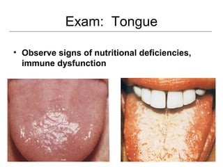 Exam: Tongue
• Observe signs of nutritional deficiencies,
immune dysfunction
 