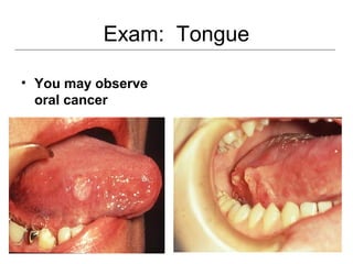 Exam: Tongue
• You may observe
oral cancer
 