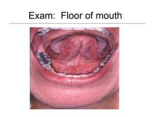 Exam: Floor of mouth
 
