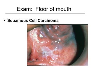 Exam: Floor of mouth
• Squamous Cell Carcinoma
 