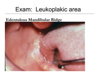 Exam: Leukoplakic area
Edentulous Mandibular Ridge
 