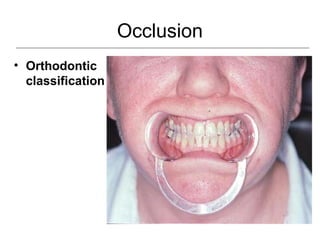 Occlusion
• Orthodontic
classification
 