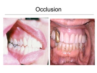 Occlusion
 