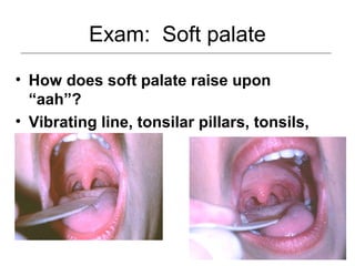 Exam: Soft palate
• How does soft palate raise upon
“aah”?
• Vibrating line, tonsilar pillars, tonsils,
oropharynx
 
