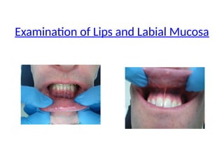 Examination of Lips and Labial Mucosa
 