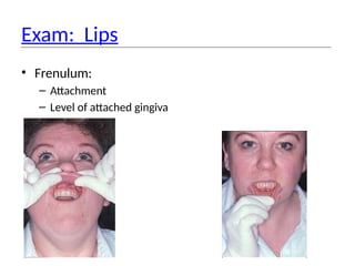 Exam: Lips
• Frenulum:
– Attachment
– Level of attached gingiva
 