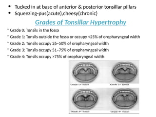 • Tucked in at base of anterior & posterior tonsillar pillars
• Squeezing-pus(acute),cheesy(chronic)
Grades of Tonsillar Hypertrophy
* Grade 0: Tonsils in the fossa
* Grade 1: Tonsils outside the fossa or occupy <25% of oropharyngeal width
* Grade 2: Tonsils occupy 26–50% of oropharyngeal width
* Grade 3: Tonsils occupy 51–75% of oropharyngeal width
* Grade 4: Tonsils occupy >75% of oropharyngeal width
 