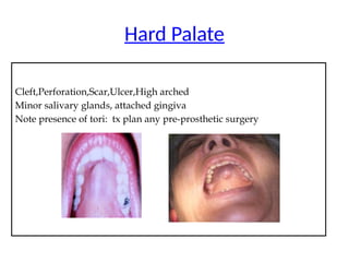 Cleft,Perforation,Scar,Ulcer,High arched
Minor salivary glands, attached gingiva
Note presence of tori: tx plan any pre-prosthetic surgery
Hard Palate
 