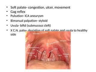 • Soft palate- congestion, ulcer, movement
• Gag reflex
• Pulsation- ICA aneurysm
• Bimanual palpation- styloid
• Uvula- bifid (submucous cleft)
• X C.N. palsy- deviation of soft palate and uvula to healthy
side
 