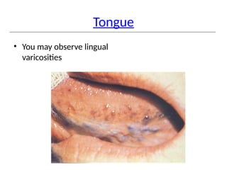 Tongue
• You may observe lingual
varicosities
 