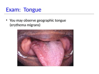 Exam: Tongue
• You may observe geographic tongue
(erythema migrans)
 