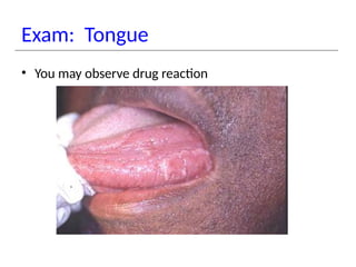 Exam: Tongue
• You may observe drug reaction
 