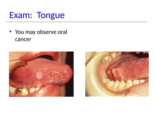 Exam: Tongue
• You may observe oral
cancer
 