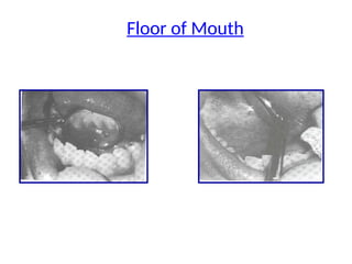 Floor of Mouth
 