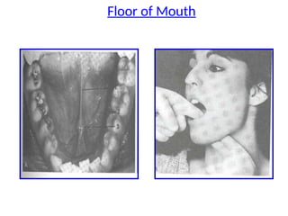 Floor of Mouth
 