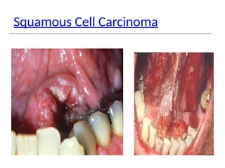 Squamous Cell Carcinoma
 