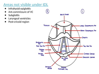 Areas not visible under IDL
● Infrahyoid epiglottis
● Ant.commissure of VC
● Subglottis
● Laryngeal ventricles
● Post-cricoid region
 
