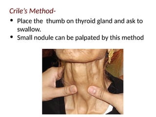 Crile’s Method-
• Place the thumb on thyroid gland and ask to
swallow.
• Small nodule can be palpated by this method
 