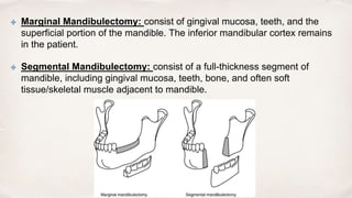 Marginal Tooth Incision oral cavity radiology.pptx radiation oncology | PPTX