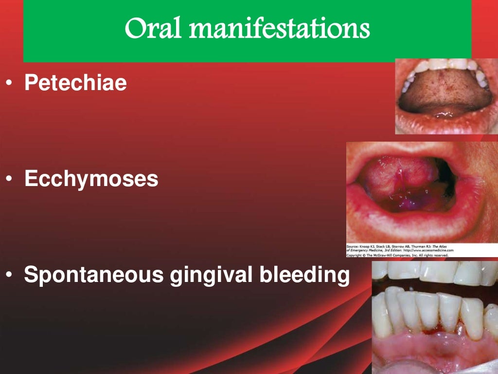 Oral consideration and laboratory investigations of bleeding and clot…