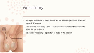 Vasectomy
– A surgical procedure to resect / close the vas deferens (the tubes that carry
sperm to the penis)
– Conventional vasectomy – one or two incisions are made in the scrotum to
reach the vas deferens
– No-scalpel vasectomy – a puncture is made in the scrotum
 