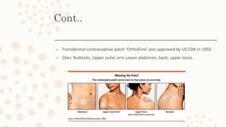 Cont..
– Transdermal contraceptive patch ‘OrthoEvra’ was approved by US FDA in 1992.
– Sites: Buttocks, Upper outer arm Lower abdomen, back, upper torso.
 
