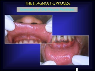 THE DIAGNOSTIC PROCESS 
Examination of Oral Mucous Membrane 
 