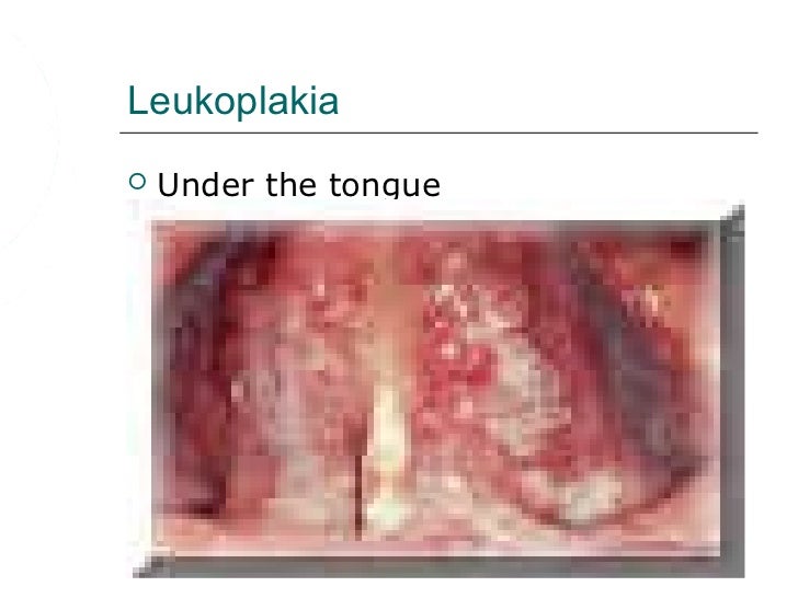 Oral effects of_smokeless_tobacco