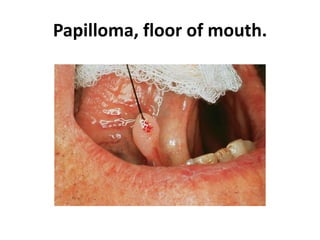 Papilloma, floor of mouth.
 