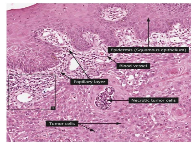Oral epithelial tumor