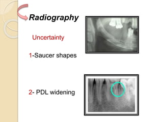 Radiography
Uncertainty
1-Saucer shapes
2- PDL widening
 
