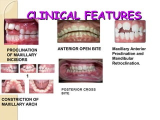 CLINICAL FEATURES
PROCLINATION
OF MAXILLARY
INCISIORS

ANTERIOR OPEN BITE

POSTERIOR CROSS
BITE

CONSTRICTION OF
MAXILLARY ARCH

Maxillary Anterior
Proclination and
Mandibular
Retroclination.

 