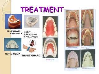 TREATMENT
BLUE GRASS
HABIT
APPLIANCE BREACKING

APPLIANCES

QURD HELIX

THUMB GUARD

 