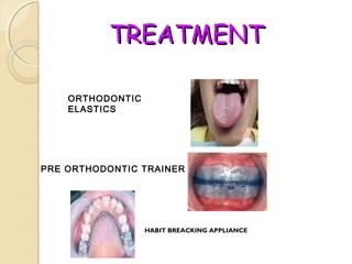 TREATMENT
ORTHODONTIC
ELASTICS

PRE ORTHODONTIC TRAINER

HABIT BREACKING APPLIANCE

 