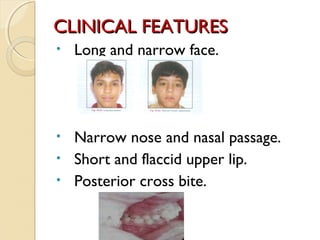 CLINICAL FEATURES
•

Long and narrow face.

Narrow nose and nasal passage.
• Short and flaccid upper lip.
• Posterior cross bite.
•

 