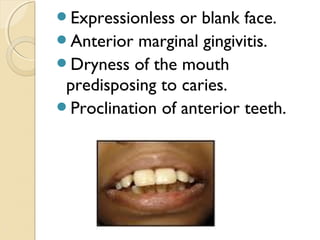 Expressionless

or blank face.
Anterior marginal gingivitis.
Dryness of the mouth
predisposing to caries.
Proclination of anterior teeth.

 