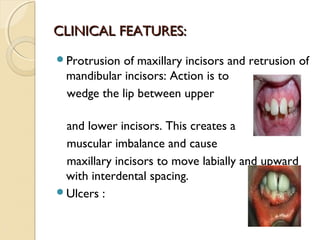 CLINICAL FEATURES:
Protrusion

of maxillary incisors and retrusion of
mandibular incisors: Action is to
wedge the lip between upper

and lower incisors. This creates a
muscular imbalance and cause
maxillary incisors to move labially and upward
with interdental spacing.
Ulcers :

 
